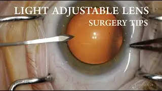 Light Adjustable Lens (LAL) Surgery Tips. Implanting the LAL by RxSight is SO EASY!