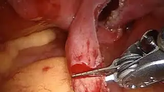Laparoscopic Tubectomy surgery animation / Surgery/fallopian tube surgery. @CPGhosh