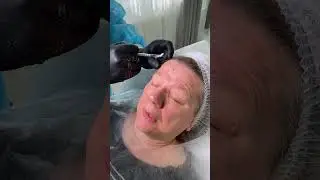 Коррекция ботулотоксином мимических морщин лба, мимических морщин возле глаз и межбровья.