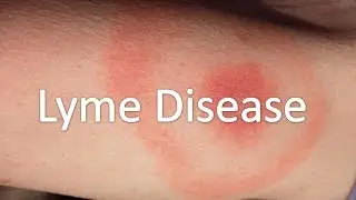 Lyme Disease