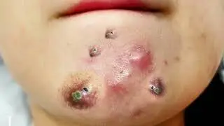 Blackheads, Pimples and Whiteheads!   Forget the Censors