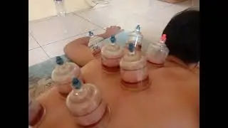 Membekam Penderita Asam Lambung