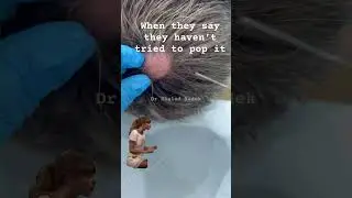 Dr Khaled Sadek #skincare cyst removal LIPOMACYST clinic