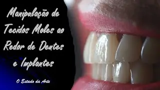 Manipulação de tecidos moles ao redor de dentes e implantes
