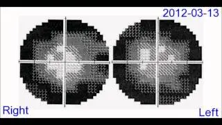 Visual Field Tests
