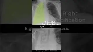 Right Lung Atelectasis Chest X-ray 