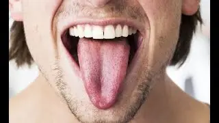 Oral Thrush | Oral Thrush Symptoms | Oral Thrush Treatment