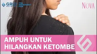 Langsung Bebas Gatal, Cara Menghilangkan Ketombe dengan Bahan ini