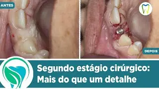 Segundo estágio Cirúrgico: mais do que um detalhe.