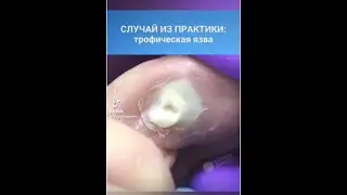 Случай из практики 5: трофическая язва 