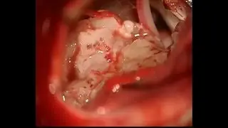 Left Acoustic Neuroma Vestibuler Schwannoma