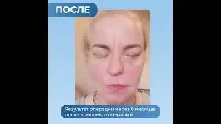 Реанимация парализованного более 20 лет лица. промежуточный результат реконструкции.