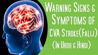 Warning Signs & Symptoms of CVA Stroke(Falij) in Urdu/Hindi
