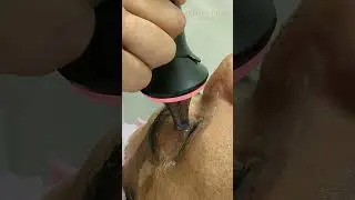 HydraFacial Treatment  afzal singer#headandfaceunisexsalonkochi