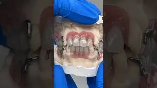 Great Chrome Cobalt Partials @EnvisiontecMain #envisiontec #lsk121shorts #teeth #dental