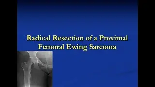 Limb Sparing Resection of the Proximal Femur due to a Ewing Sarcoma