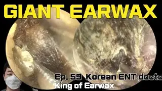 귀지형의 Ep.59 귀지제거 : 막지 (Korean otolaryngologist “King of earwax” Ep. 59 earwax removal)