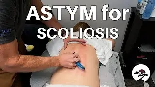 Scoliosis Back Pain Treated with ASTYM (Tool Assisted Manual Therapy)