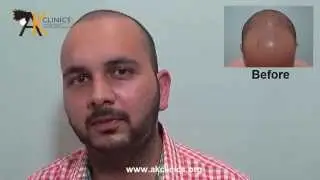 FUE Hair Transplant Results in India - 4000 Grafts, Dr Kapil Dua