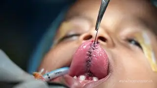 SEVERE TONGUE TIE (Minor Surgery and we Fixed It)