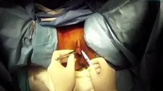 Vaginoplastia  /  Vaginoplasty