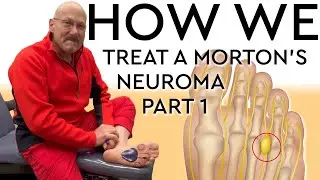 How We Treat A Morton's Neuroma Part 1