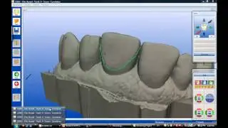 #9 Cerec Empress crown,post and core, crown lengthening