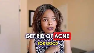 HOW I GOT RID OF MY ACNE SITUATION 🙃