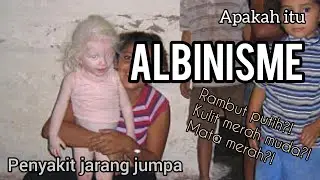 Albinisme | Rambut putih, kulit merah muda , mata merah| Apakah itu Albinisme