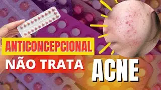 ANTICONCEPCIONAL NÃO TRATA ACNE HORMONAL (espinhas)?? Você foi enganada esse tempo todo