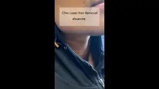 Review Chin Laser Hair Removal