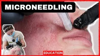 Microneedling Full Procedure Training Video (2024)