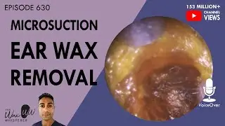 630 - Ear Wax Removal Microsuction