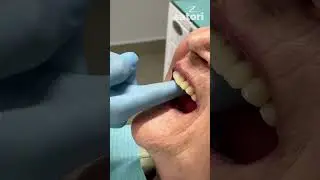 Complete removable denture 