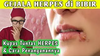 A Complete Guide to Lip Herpes and How to Treat It || Dr. Andi