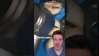 Dentista quita una caries. #dentista #caries #dentistryworld #turbina #odontología #drgattoni