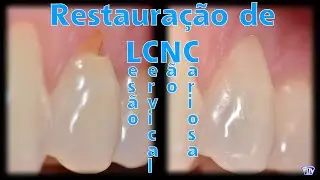 Restauração de Lesão Cervical Não Cariosa (LCNC)