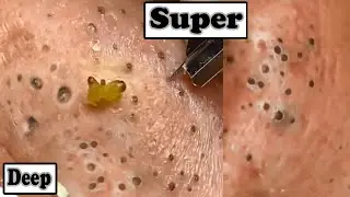 Removal Of Big Deep Blackheads Amazing