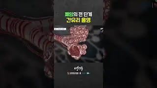 흉부CT에서 뿌옇게 보인 ‘이것’은?