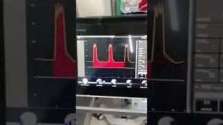 Ventilación mecánica Dr. Aquiles Hidalgo
