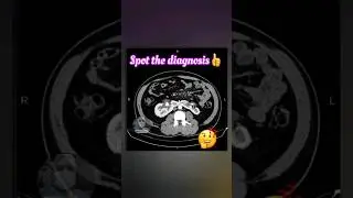 Spot the diagnosis from the CECT abdomen and pelvis shown? #youtubeshorts #neet #video #trending