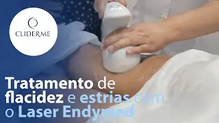 TRATAMENTO de ESTRIAS e FLACIDEZ - Laser Endymed