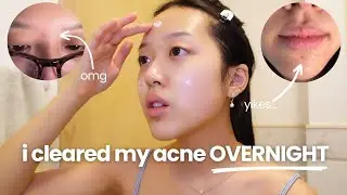 How I Get Rid of Acne FAST (great for sensitive skin!)