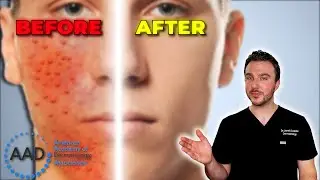 New 2024 Acne Guidelines: AAD's Latest Recommendations!