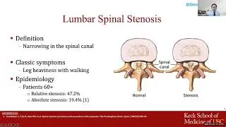 Spinal Stenosis – An Overview and Non-Surgical Approach