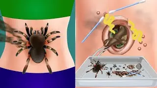 ASMR Cleansing Of Belly Button, Removing Bug And Navel Stones - ASMR Care Animation | JINJJA 진짜 ASMR