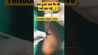 What Happened When Foot Tendon Get Injured..?? 