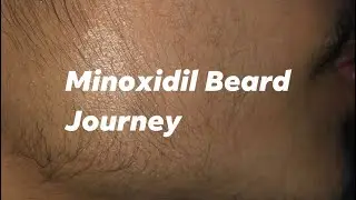 MONTH 6: Beard Journey | Pros and Cons of Minoxidil Gel Type