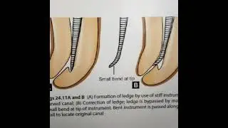 How to avoid ledge formation during root canal preparation?