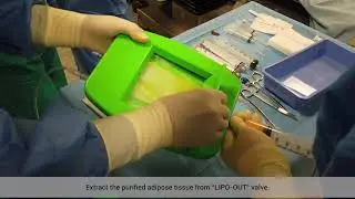 LIPO-STEM™surgical session: Hip osteoarthritis treatment with adipose-derived mesenchymal stem cells